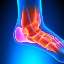 Sports Injuries 201: Foot Conditions; Diagnosis & Treatment image
